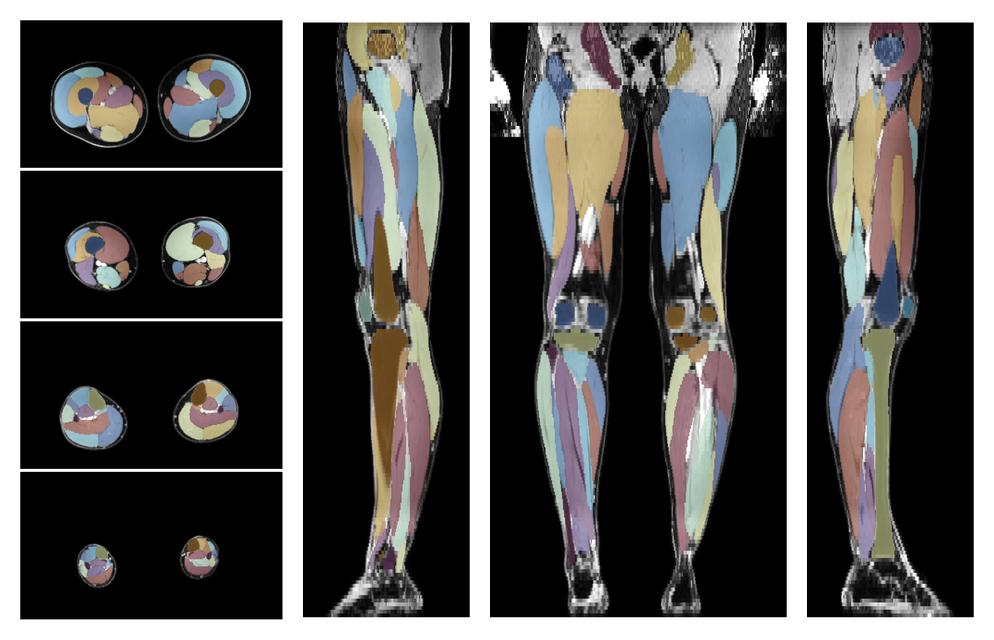 Overlay of automated muscle segmentation labels on dixon water image.